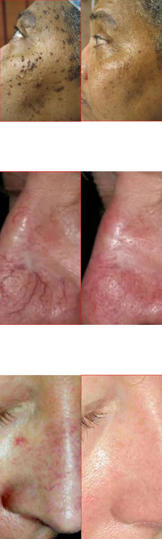 KTP Laser Skin Treatments