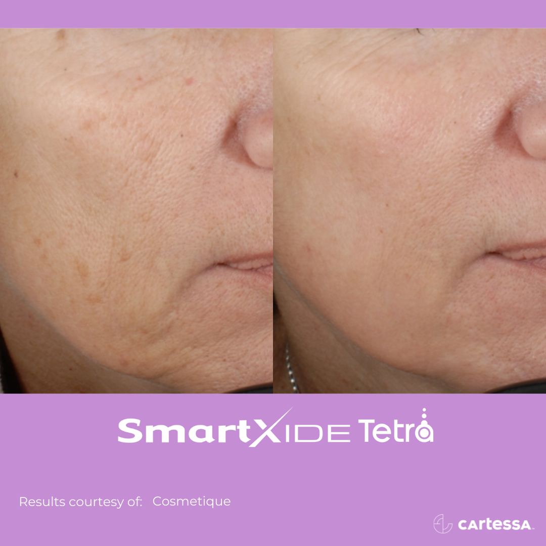 Tetra Skin Laser Treatment